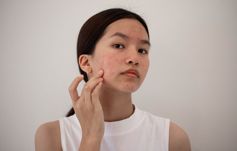 Woman with sensitive skin