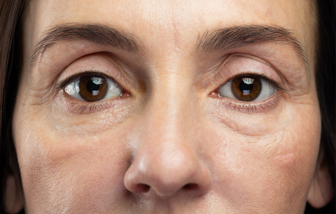 Tired and puffy eyes